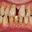 Periodontitis